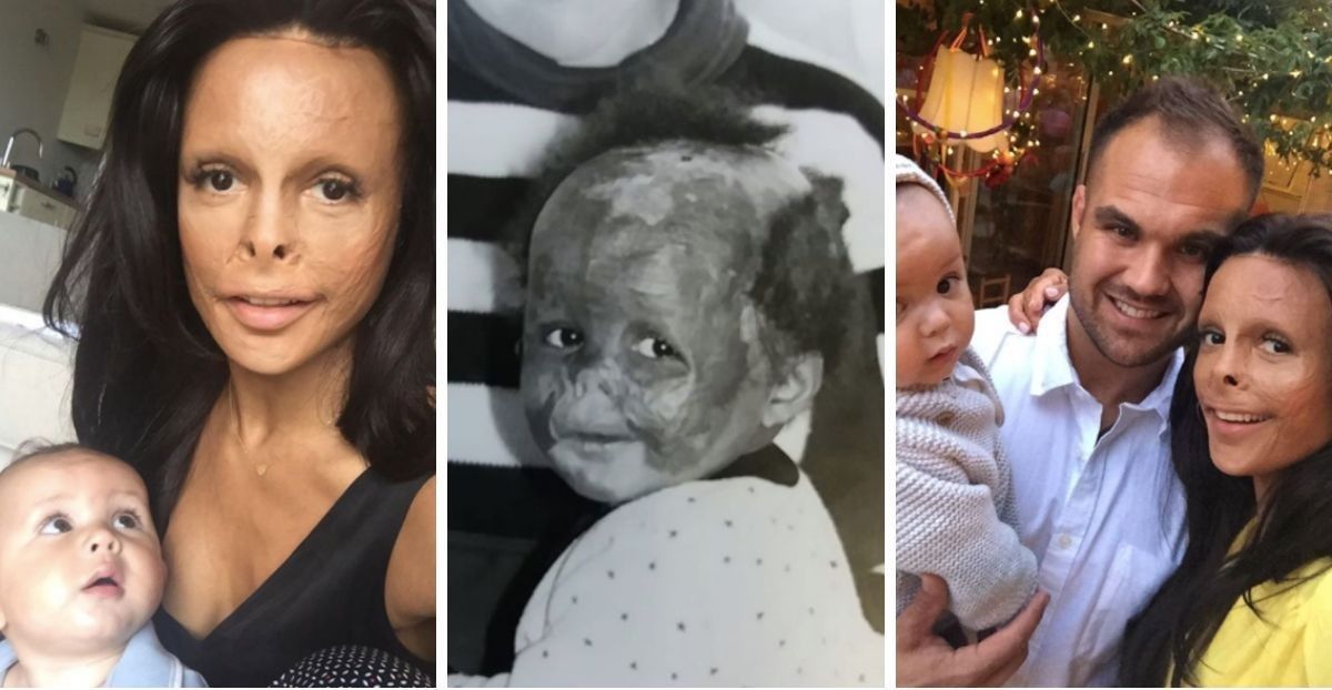 Woman Learns The Life-changing Truth Behind Her Burn Scars