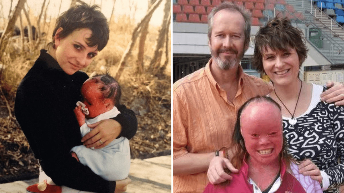 Red-Skinned Newborn Baby Is Abandoned by Her Parents - But a Couple Who Can't Have Their Own Kids Take Her In