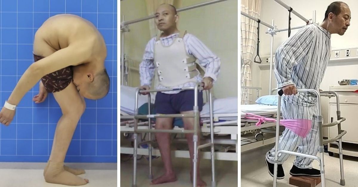 After 28 Years, 'Folded Man' Finally Stands Straight Thanks To One Doctor Who Never Gave Up