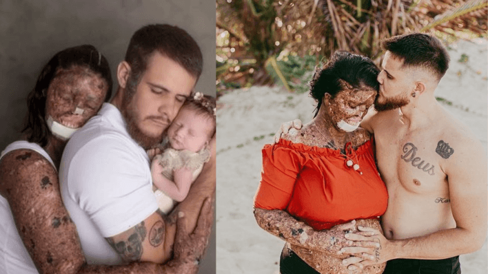 woman with rare skin condition hugging her husband and baby